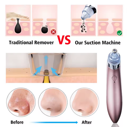EXTRACTOR DE COMEDONES